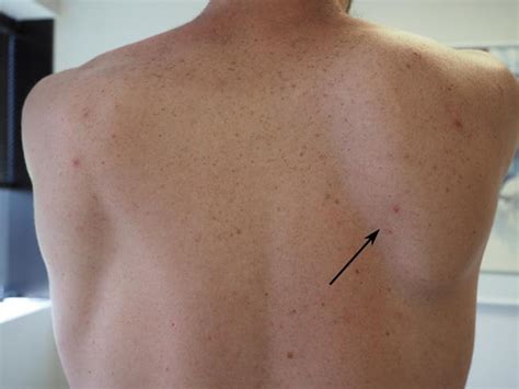 It is caused by misaligned nerves in the spine. . Itchy shoulder blades and cancer
